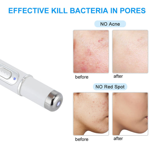 Spot Blue Light Acne Pen Eye Massager To Remove Eye Bags And Fade Dark Circles Massage Stick Beauty Eye Instrument